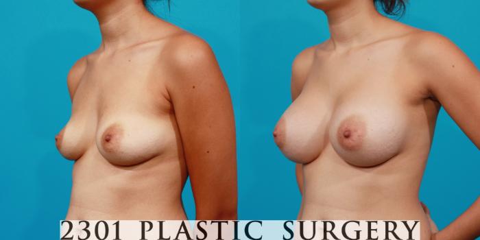 Before & After Saline Implants Case 150 View #3 View in Fort Worth, Plano, & Frisco, Texas