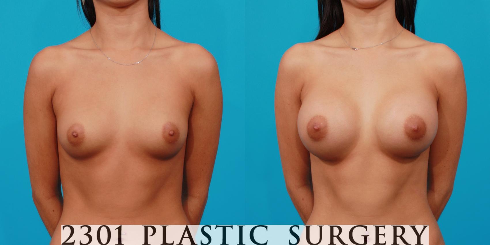 Before & After Saline Implants Case 152 View #1 View in Fort Worth & Frisco, Texas