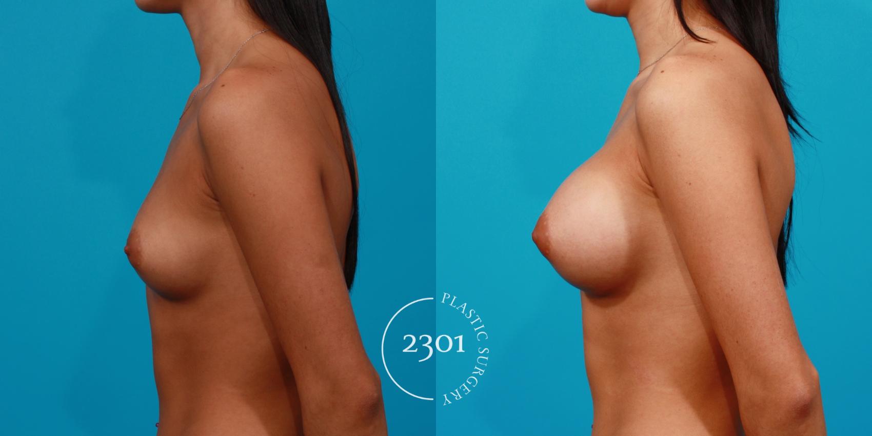 Before & After Saline Implants Case 152 View #2 View in Fort Worth, Plano, & Frisco, Texas