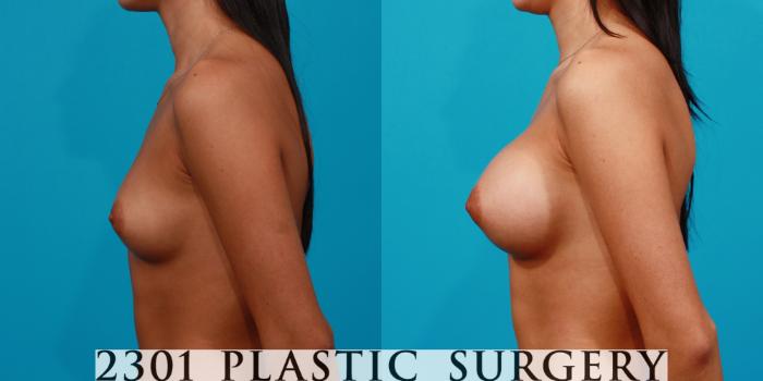 Before & After Breast Augmentation Case 152 View #2 View in Fort Worth, Plano, & Frisco, Texas