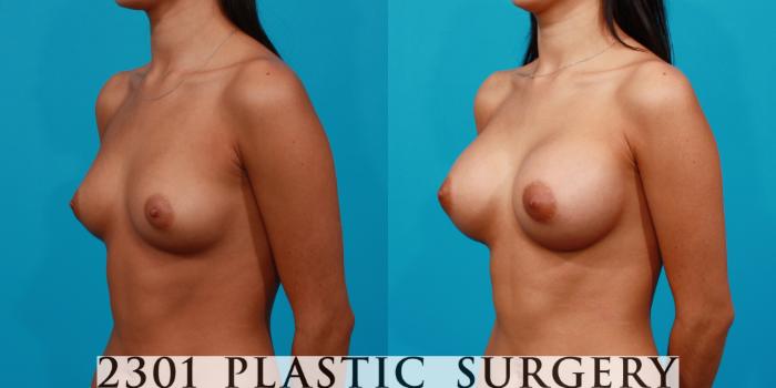Before & After Breast Augmentation Case 152 View #3 View in Fort Worth, Plano, & Frisco, Texas