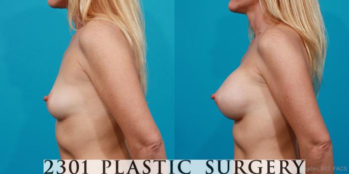 Before & After Saline Implants Case 169 View #2 View in Fort Worth, Plano, & Frisco, Texas