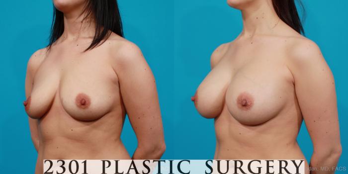 Before & After Saline Implants Case 170 View #3 View in Fort Worth, Plano, & Frisco, Texas
