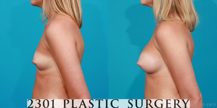 Before & After Saline Implants Case 179 View #2 View in Fort Worth, Plano, & Frisco, Texas