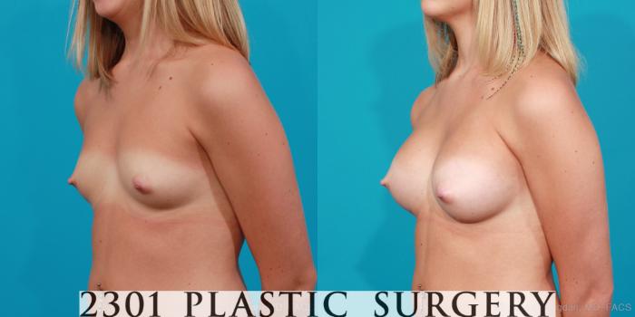 Before & After Saline Implants Case 179 View #3 View in Fort Worth, Plano, & Frisco, Texas