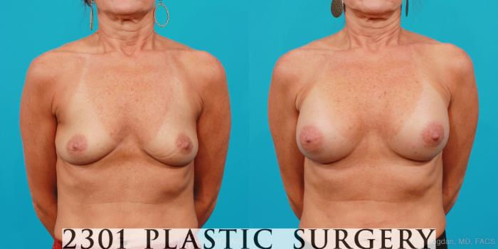 Before & After Saline Implants Case 180 View #1 View in Fort Worth, Plano, & Frisco, Texas