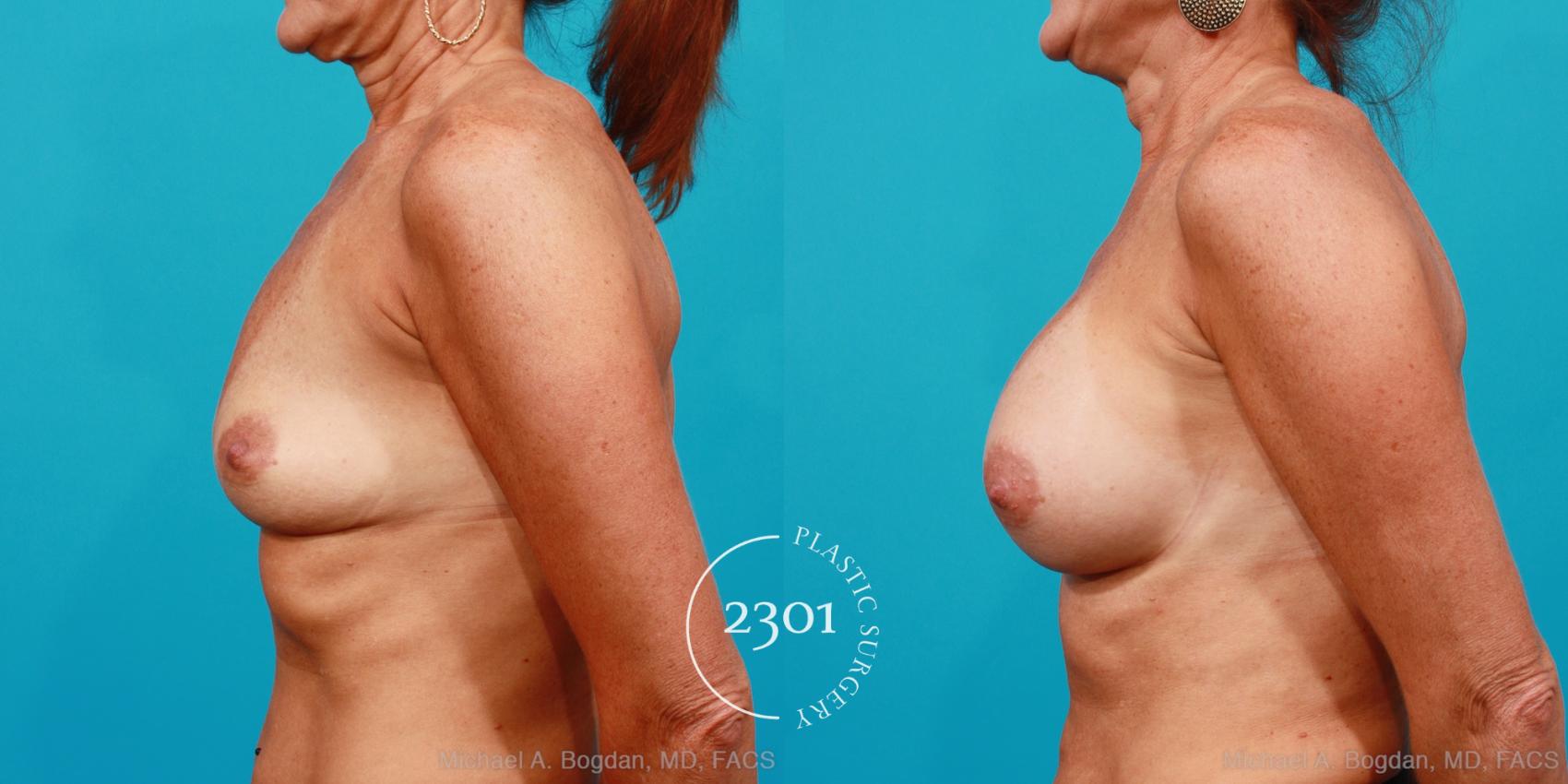 Before & After Saline Implants Case 180 View #2 View in Fort Worth, Plano, & Frisco, Texas