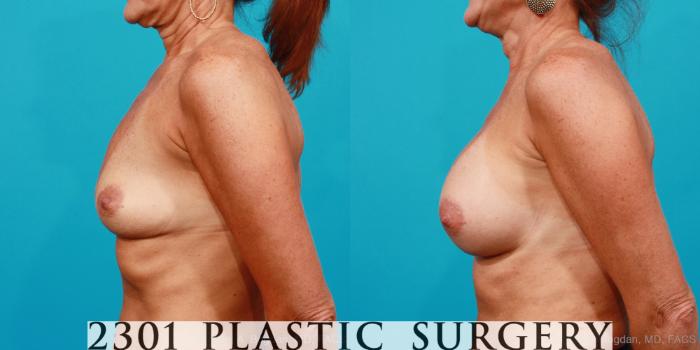 Before & After Saline Implants Case 180 View #2 View in Fort Worth, Plano, & Frisco, Texas