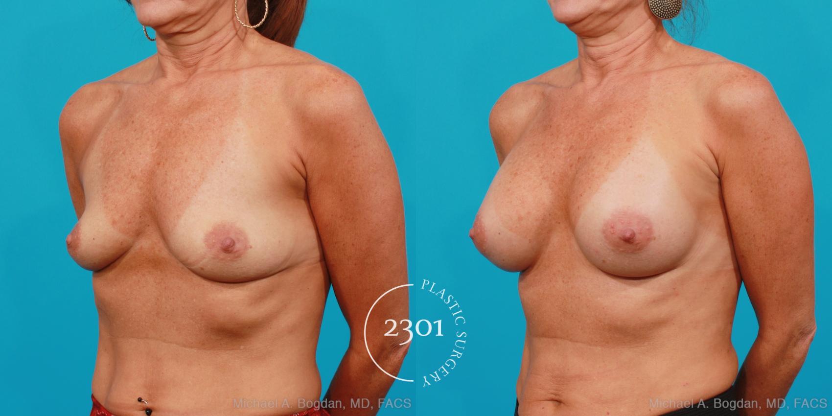 Before & After Saline Implants Case 180 View #3 View in Fort Worth, Plano, & Frisco, Texas