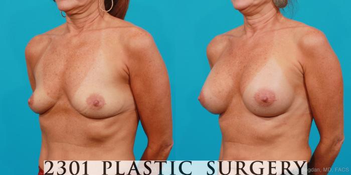 Before & After Saline Implants Case 180 View #3 View in Fort Worth, Plano, & Frisco, Texas