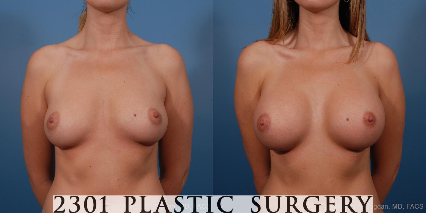 Before & After Saline Implants Case 193 View #1 View in Fort Worth, Plano, & Frisco, Texas