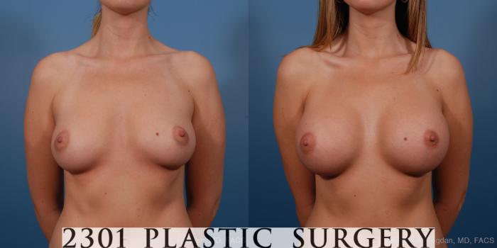 Before & After Saline Implants Case 193 View #1 View in Fort Worth, Plano, & Frisco, Texas