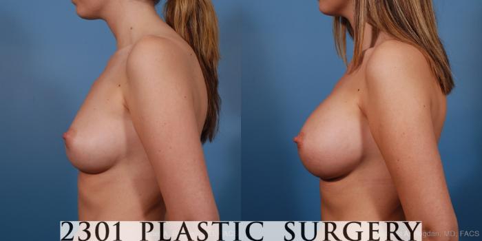 Before & After Saline Implants Case 193 View #2 View in Fort Worth, Plano, & Frisco, Texas