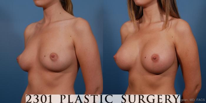 Before & After Saline Implants Case 193 View #3 View in Fort Worth, Plano, & Frisco, Texas