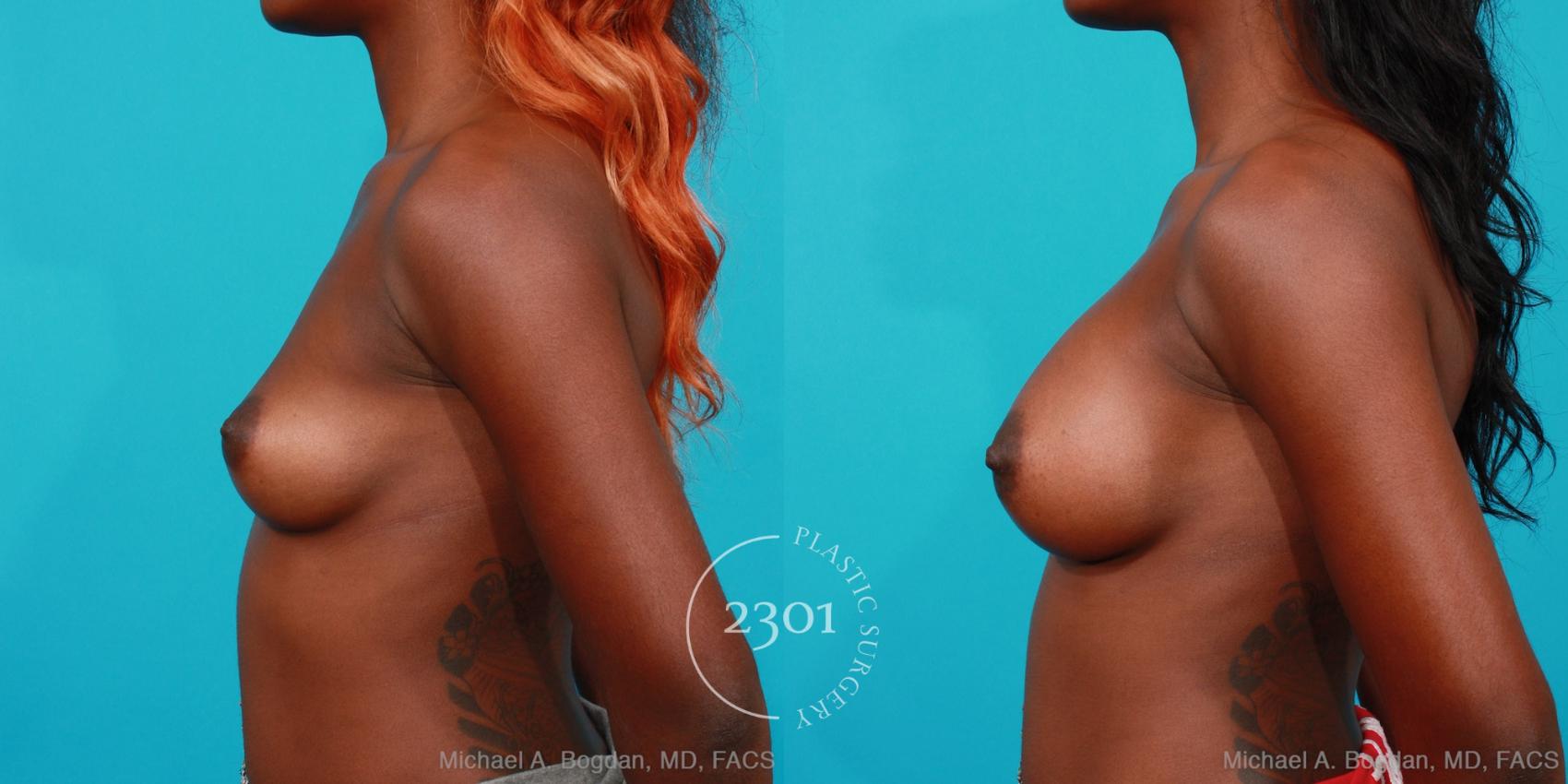 Before & After Saline Implants Case 219 View #2 View in Fort Worth, Plano, & Frisco, Texas
