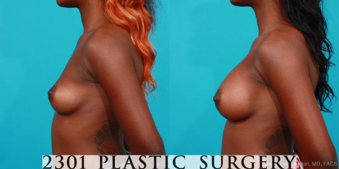 Before & After Saline Implants Case 219 View #2 View in Fort Worth, Plano, & Frisco, Texas