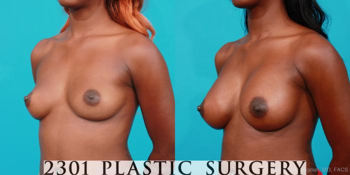 Before & After Saline Implants Case 219 View #3 View in Fort Worth, Plano, & Frisco, Texas