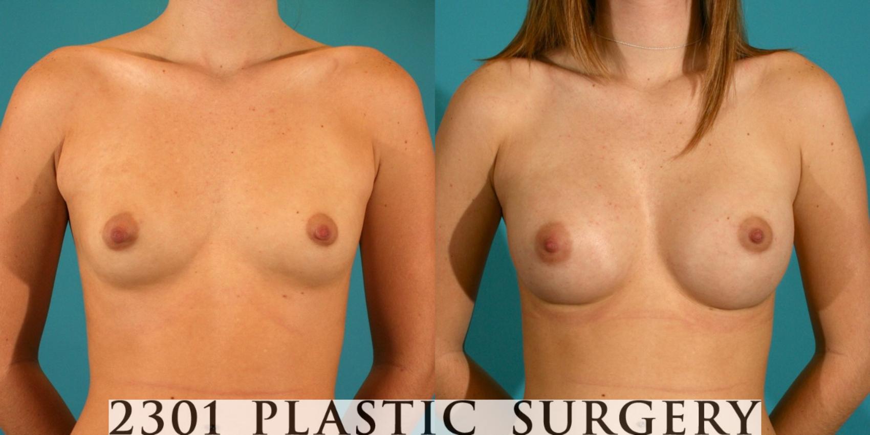 Before & After Saline Implants Case 23 View #1 View in Fort Worth & Frisco, Texas