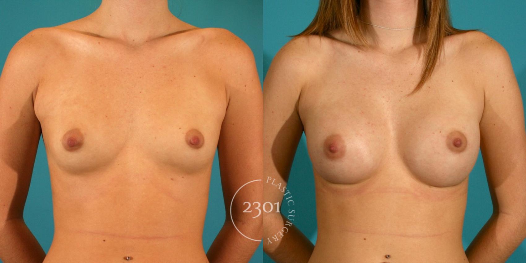 Before & After Saline Implants Case 23 View #1 View in Fort Worth, Plano, & Frisco, Texas