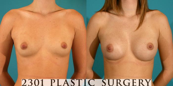 Before & After Breast Augmentation Case 23 View #1 View in Fort Worth, Plano, & Frisco, Texas