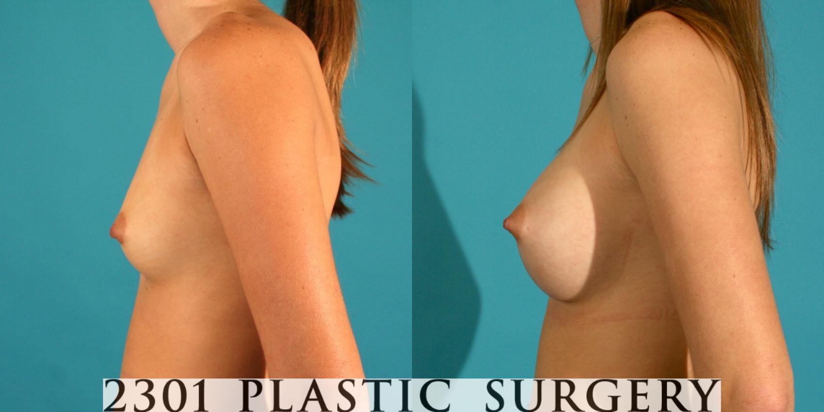 Before & After Saline Implants Case 23 View #2 View in Fort Worth & Frisco, Texas