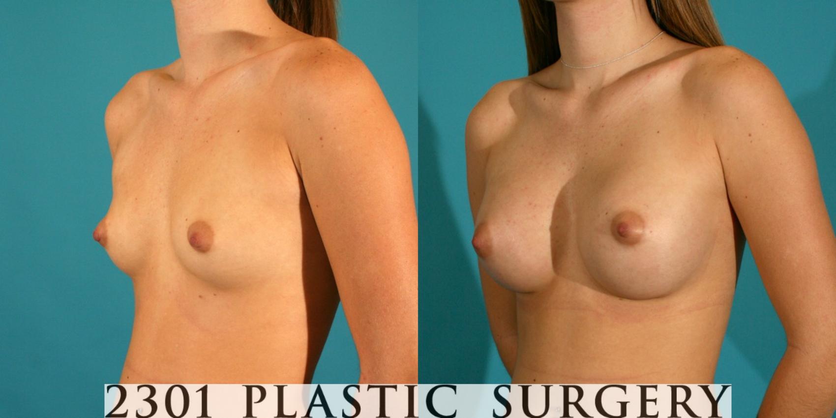 Before & After Saline Implants Case 23 View #3 View in Fort Worth & Frisco, Texas