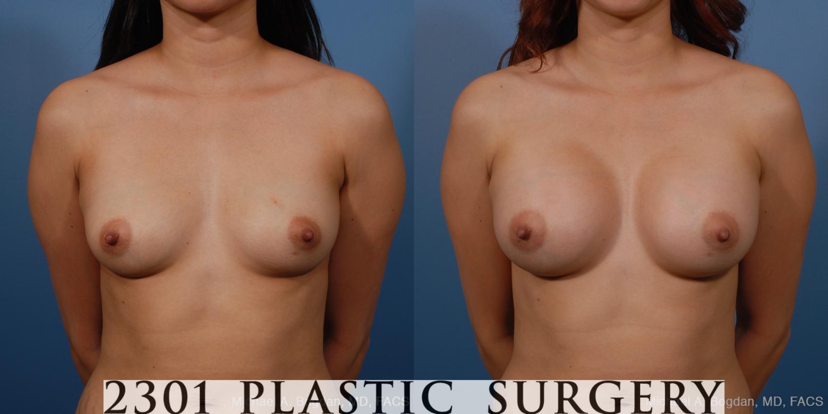 Before & After Saline Implants Case 230 View #1 View in Fort Worth & Frisco, Texas