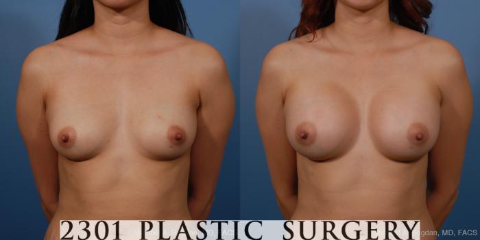 Before & After Breast Augmentation Case 230 View #1 View in Fort Worth, Plano, & Frisco, Texas