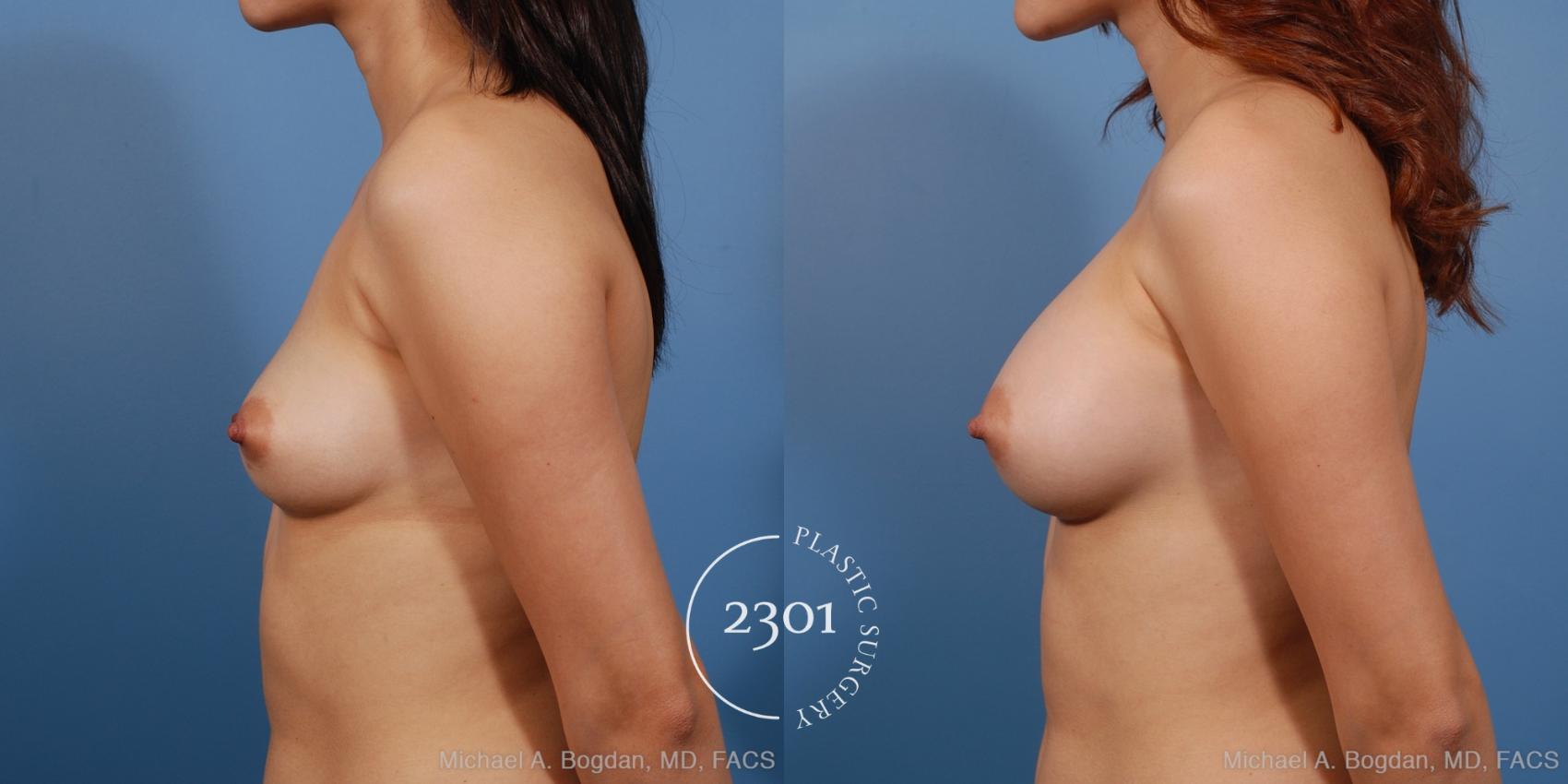 Before & After Breast Augmentation Case 230 View #2 View in Fort Worth, Plano, & Frisco, Texas