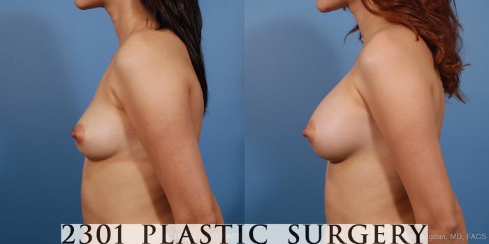 Before & After Saline Implants Case 230 View #2 View in Fort Worth, Plano, & Frisco, Texas