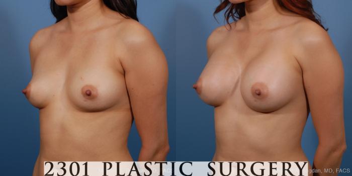 Before & After Saline Implants Case 230 View #3 View in Fort Worth, Plano, & Frisco, Texas