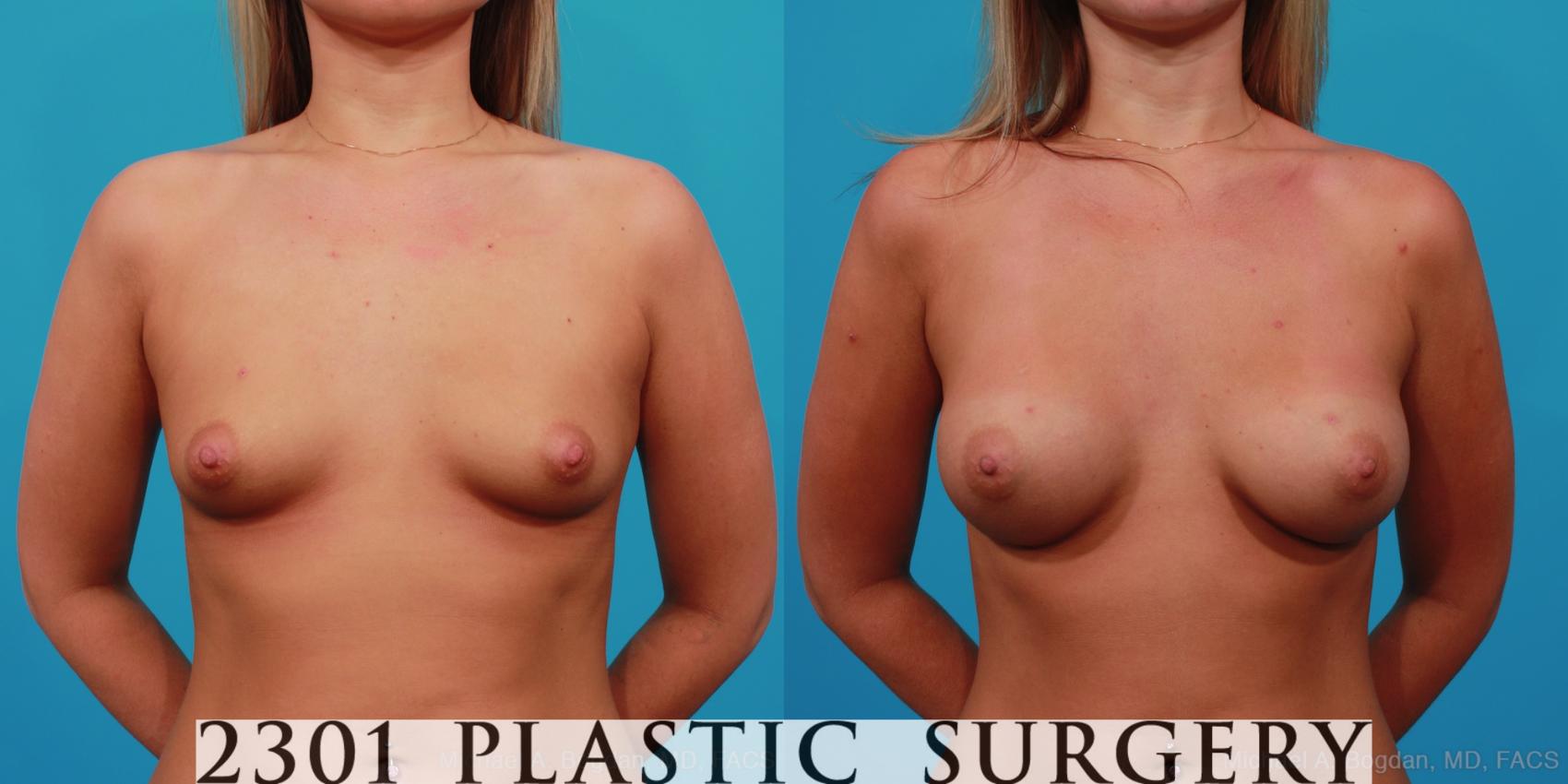 Before & After Saline Implants Case 246 View #1 View in Fort Worth, Plano, & Frisco, Texas