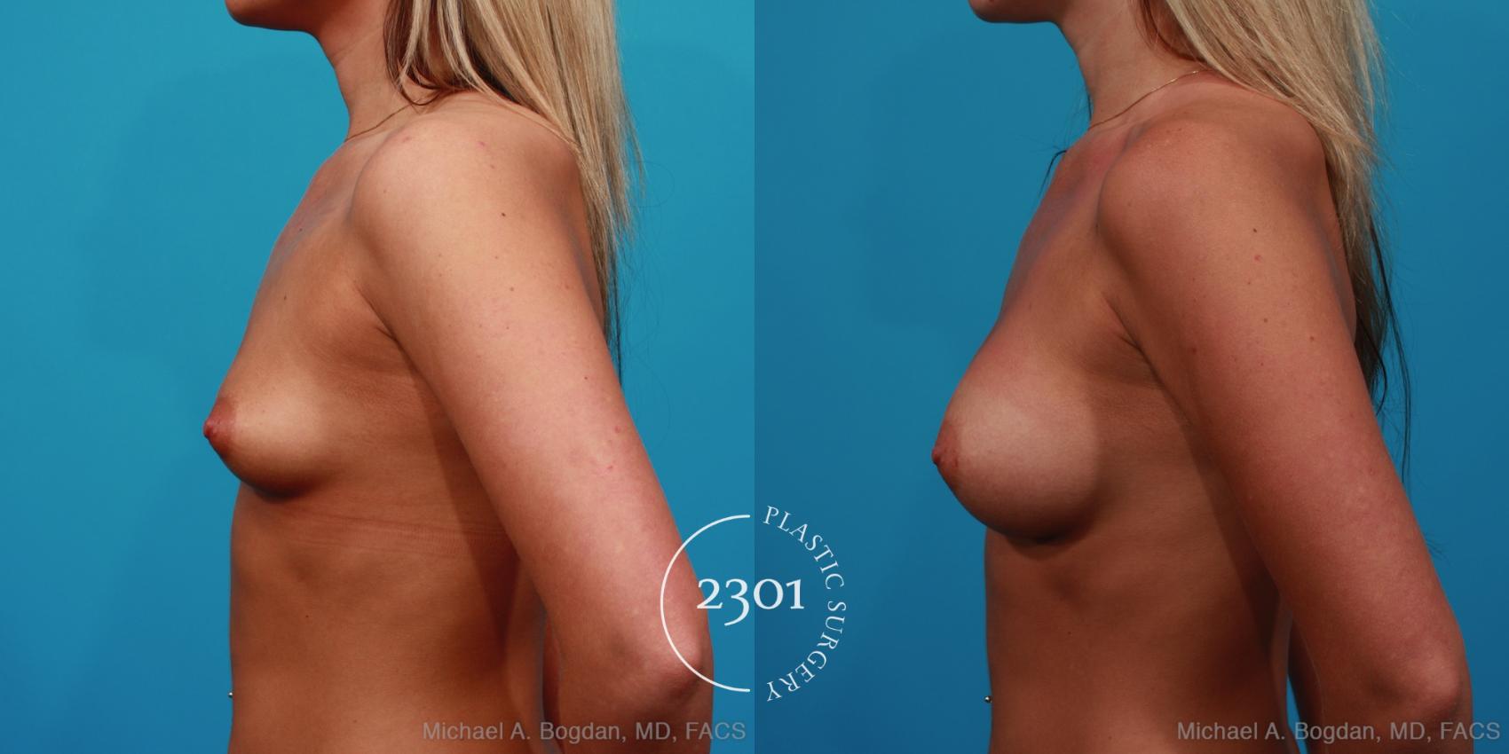 Before & After Saline Implants Case 246 View #2 View in Fort Worth, Plano, & Frisco, Texas