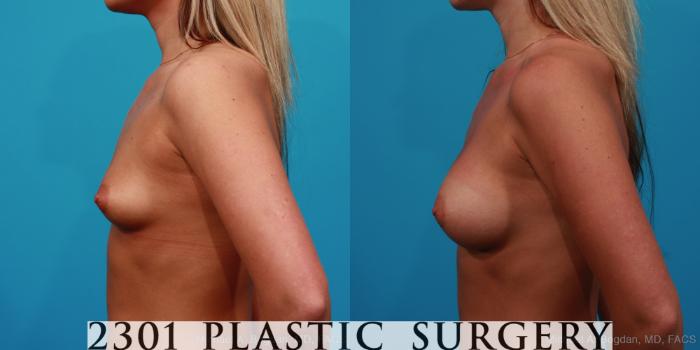 Before & After Saline Implants Case 246 View #2 View in Fort Worth, Plano, & Frisco, Texas