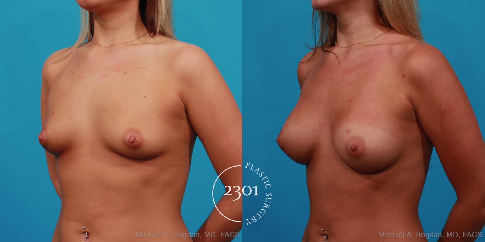 Before & After Saline Implants Case 246 View #3 View in Fort Worth, Plano, & Frisco, Texas
