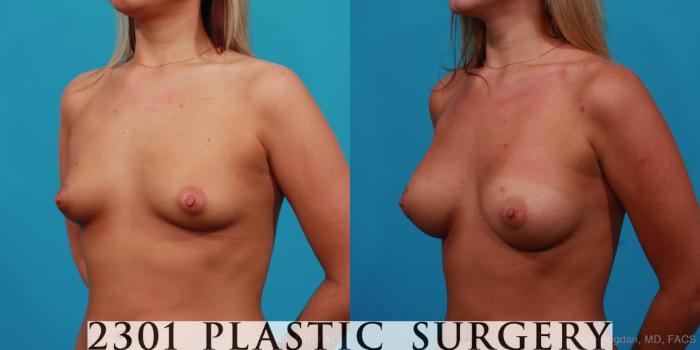 Before & After Saline Implants Case 246 View #3 View in Fort Worth, Plano, & Frisco, Texas