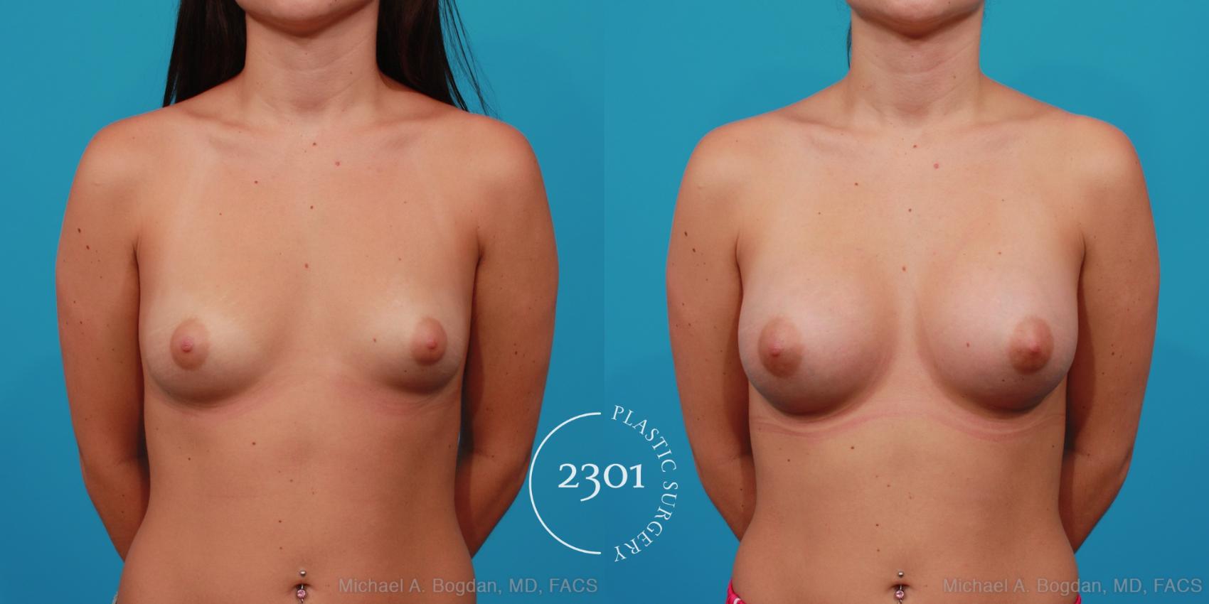 Before & After Saline Implants Case 255 View #1 View in Fort Worth, Plano, & Frisco, Texas