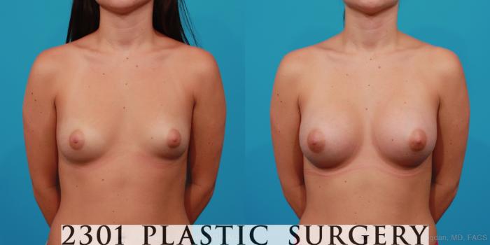 Before & After Saline Implants Case 255 View #1 View in Fort Worth, Plano, & Frisco, Texas