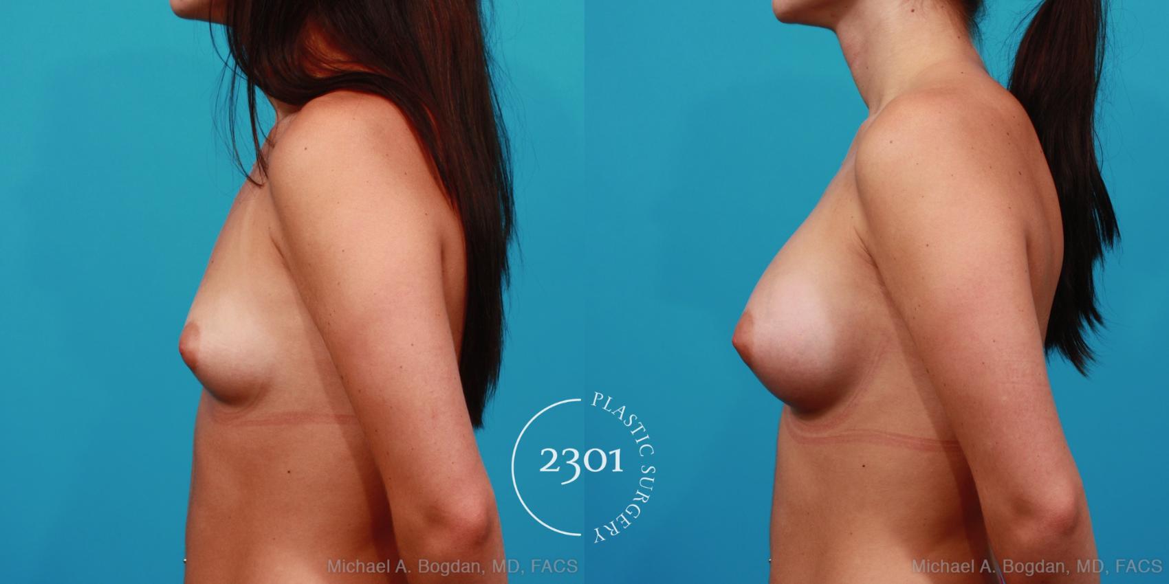 Before & After Breast Augmentation Case 255 View #2 View in Fort Worth, Plano, & Frisco, Texas
