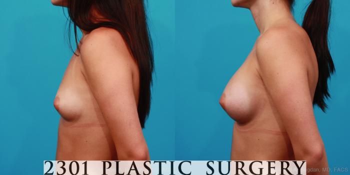 Before & After Breast Augmentation Case 255 View #2 View in Fort Worth, Plano, & Frisco, Texas
