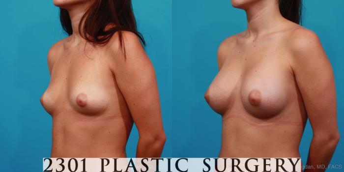 Before & After Saline Implants Case 255 View #3 View in Fort Worth, Plano, & Frisco, Texas