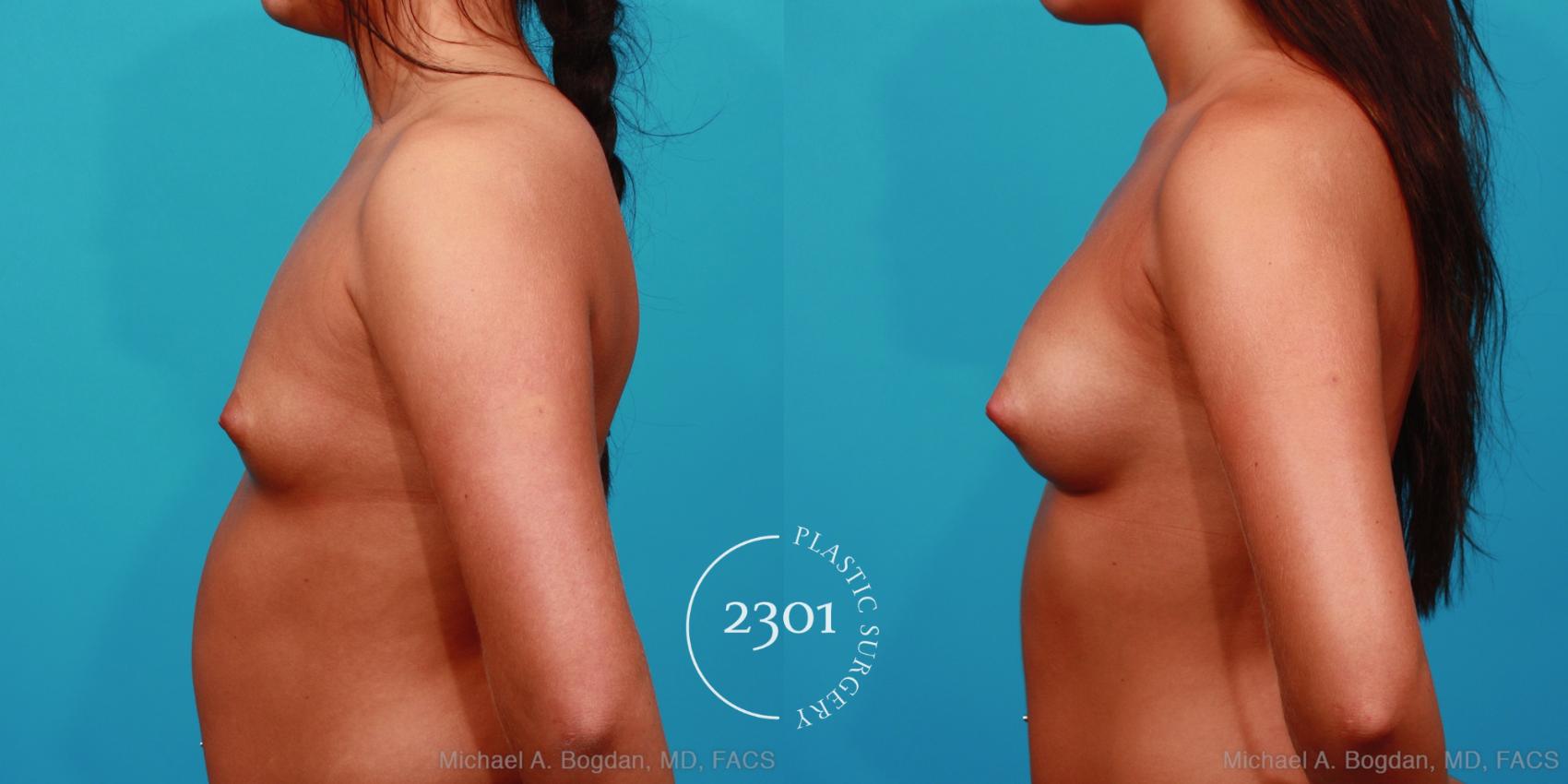 Before & After Saline Implants Case 291 View #2 View in Fort Worth, Plano, & Frisco, Texas