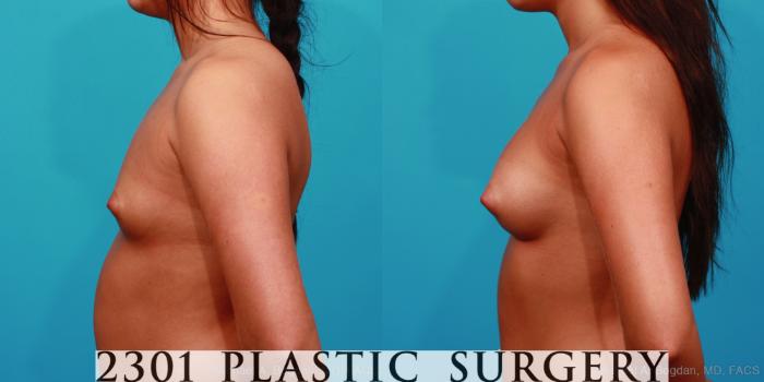 Before & After Saline Implants Case 291 View #2 View in Fort Worth, Plano, & Frisco, Texas