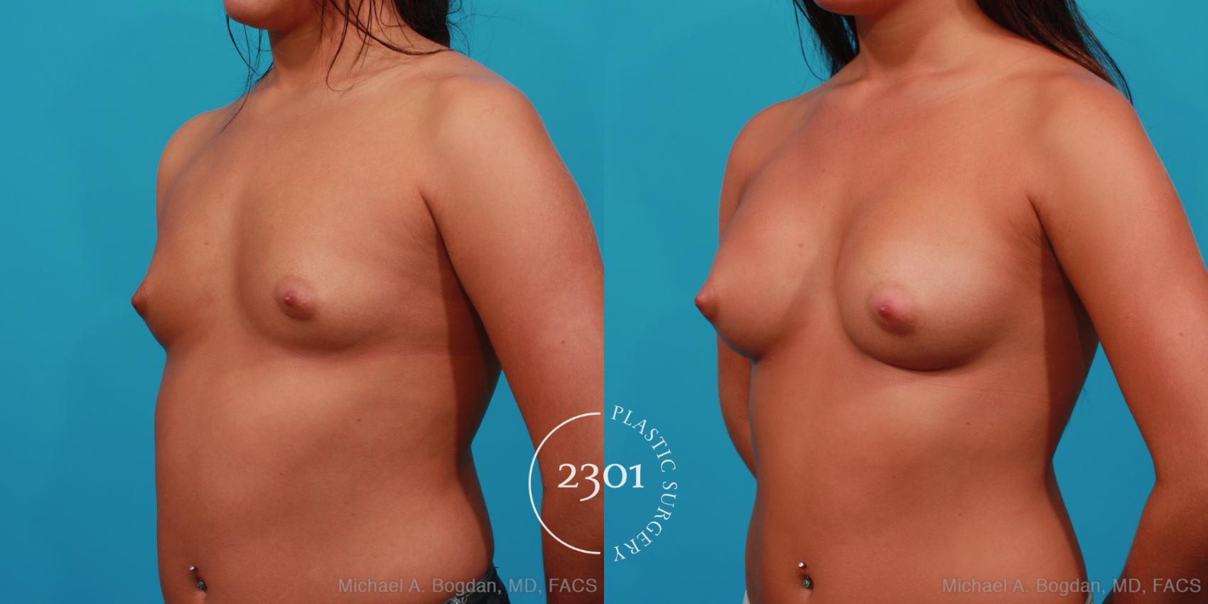 Before & After Saline Implants Case 291 View #3 View in Fort Worth, Plano, & Frisco, Texas