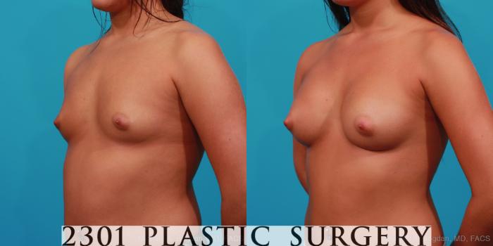 Before & After Saline Implants Case 291 View #3 View in Fort Worth, Plano, & Frisco, Texas