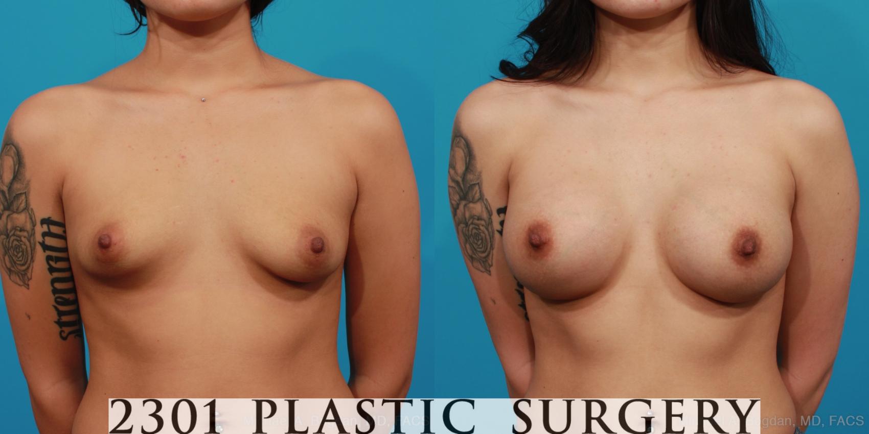 Before & After Saline Implants Case 321 View #1 View in Fort Worth, Plano, & Frisco, Texas