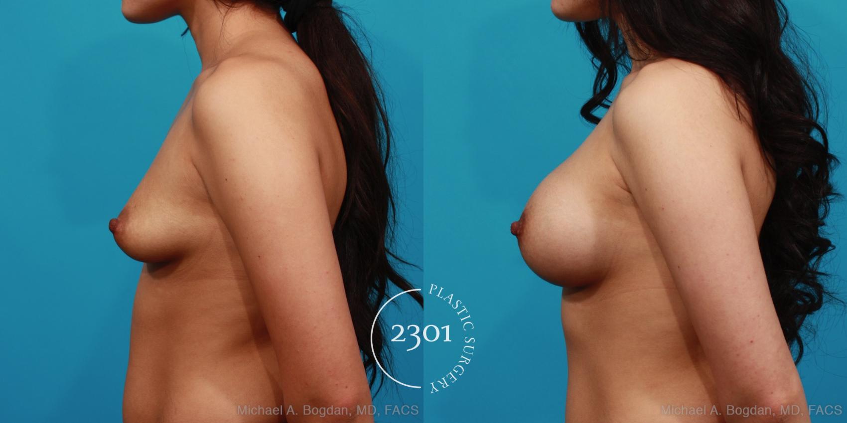 Before & After Saline Implants Case 321 View #2 View in Fort Worth, Plano, & Frisco, Texas