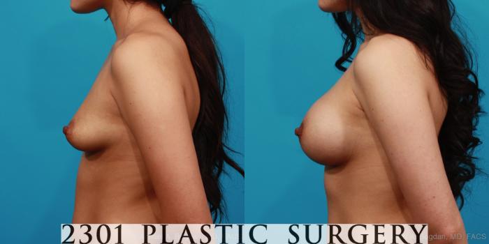 Before & After Saline Implants Case 321 View #2 View in Fort Worth, Plano, & Frisco, Texas