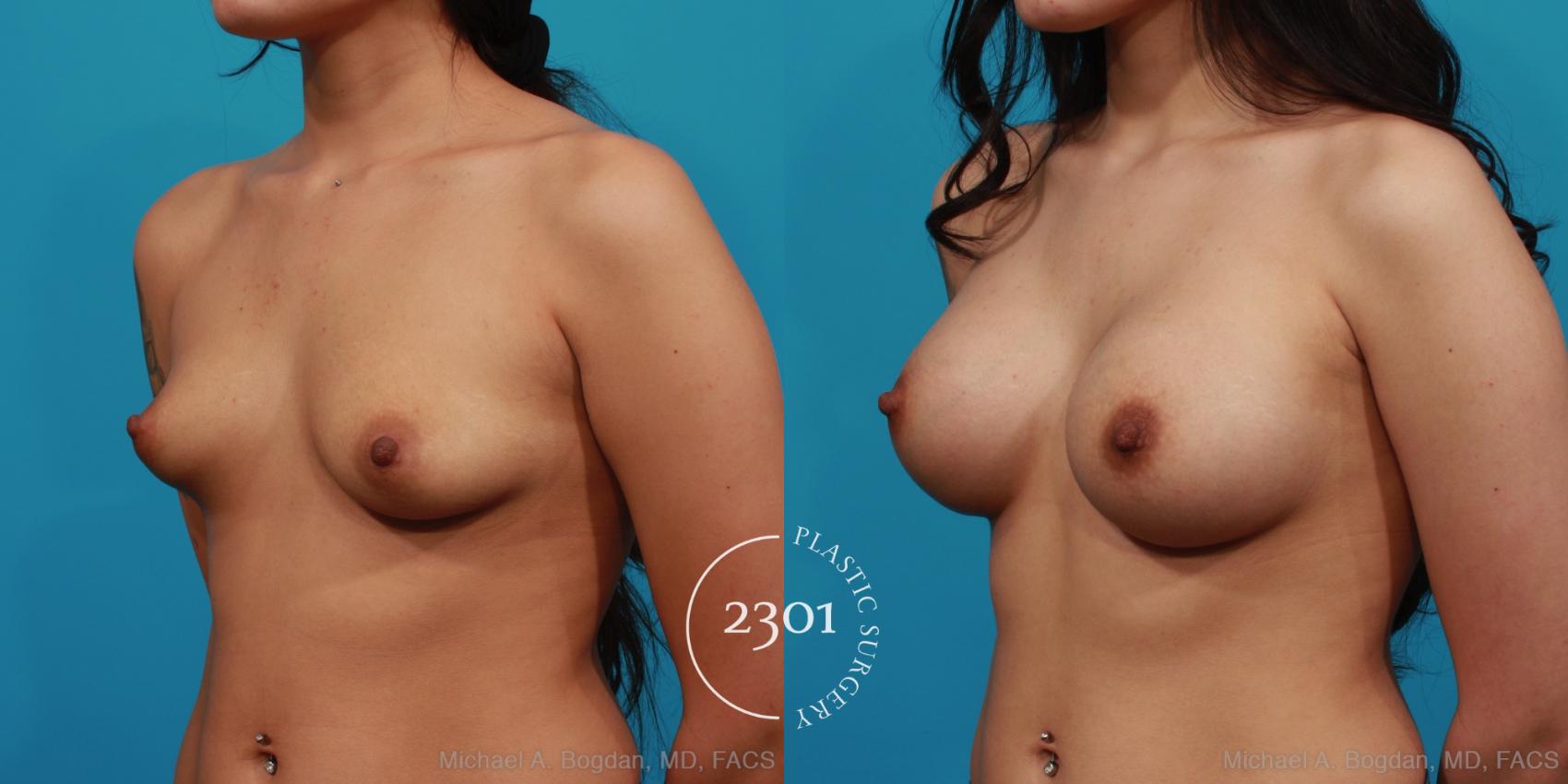 Before & After Saline Implants Case 321 View #3 View in Fort Worth, Plano, & Frisco, Texas