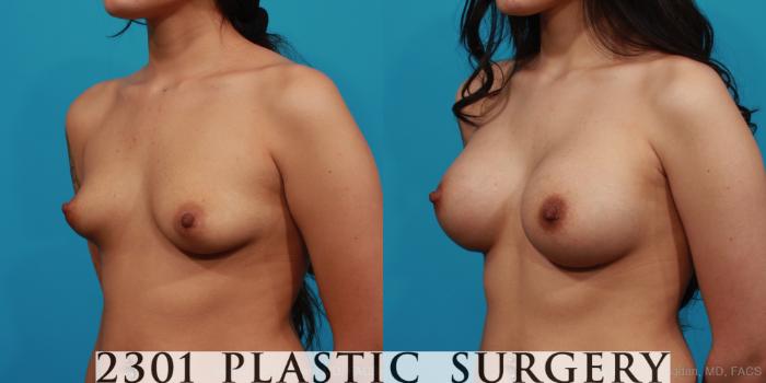 Before & After Saline Implants Case 321 View #3 View in Fort Worth, Plano, & Frisco, Texas
